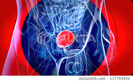 Abstract 3D illustration of the bladder cancer 117784920