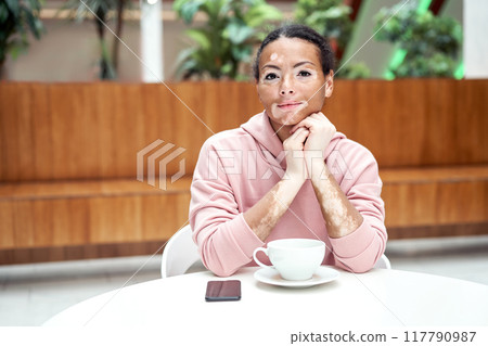 Black african american woman with vitiligo Black african american woman with vitiligo 117790987