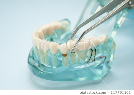 Dental teeth model with dentist tool for dentistry. Dental teeth model with dentist tool for dentistry. 117791101
