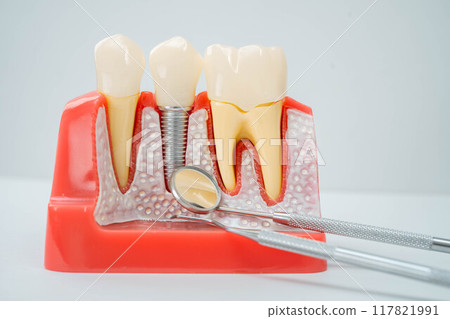 Dentist use dental tool to treatment teeth and gum in patient oral. 117821991