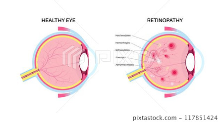 Diabetes related retinopathy 117851424