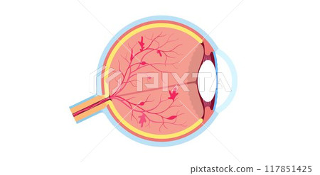 Diabetes related retinopathy Diabetes related retinopathy 117851425