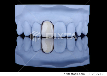Mirror copy of central maxillary incisor, ultra thin dental ceramic veneer or crown on printed model 117855439