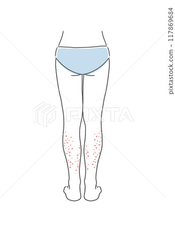 膝蓋以下皮膚粗糙的女人下半身插畫素材 膝蓋以下皮膚粗糙的女人下半身插畫素材 117869684
