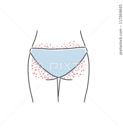 Illustration material of a woman's buttocks with rough skin (bumps) 117869685