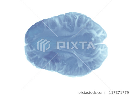 Brain MRI Showing Acute Ischemic Stroke with Necrosis 117871779