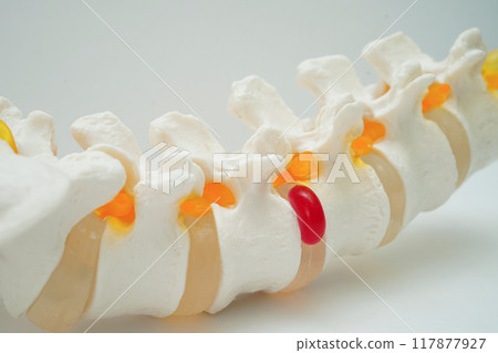 Spinal nerve and bone, Lumbar spine displaced herniated disc fragment, Model for treatment medical in the orthopedic department. Spinal nerve and bone, Lumbar spine displaced herniated disc fragment, Model for treatment medical in the orthopedic department. 117877927