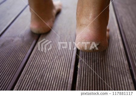 Close-up of cracked heels, skin diseases. 117881117