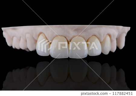 High-quality naturally dental bridge made of zirconia and stained using ceramic stains. 117882451