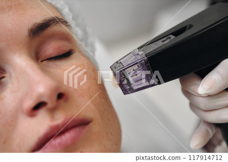 Woman receiving microneedling treatment in a skincare clinic 117914712