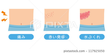 Shingles symptoms medical 117925050