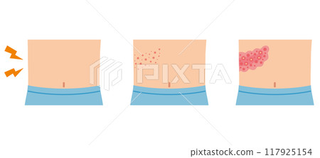 帶狀皰疹的醫療護理症狀 117925154