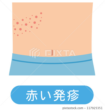 Shingles symptoms medical Shingles symptoms medical 117925351