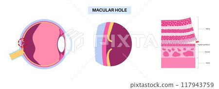 Macular hole disease Macular hole disease 117943759