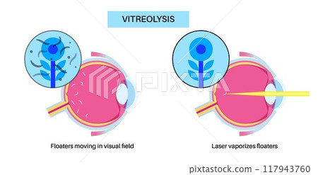Vitreolysis laser treatment Vitreolysis laser treatment 117943760