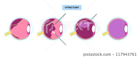 Vitrectomy surgical poster 117943761
