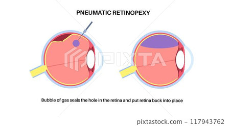 Pneumatic retinopexy poster Pneumatic retinopexy poster 117943762