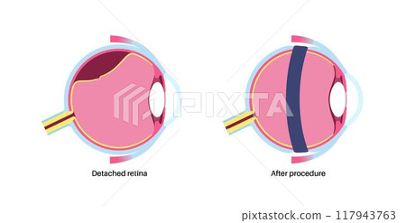 Scleral buckle procedure Scleral buckle procedure 117943763