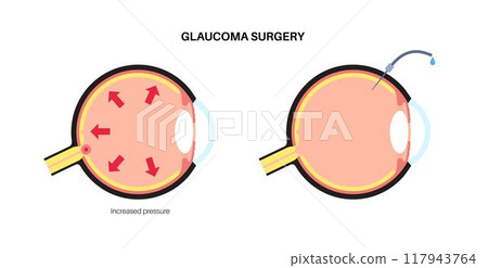 Glaucoma surgery poster Glaucoma surgery poster 117943764