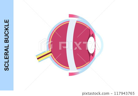 Scleral buckle procedure Scleral buckle procedure 117943765