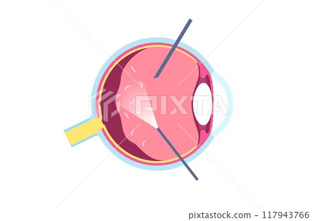 Vitreous hemorrhage poster Vitreous hemorrhage poster 117943766