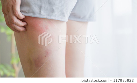 女人抓大腿濕疹 117953928