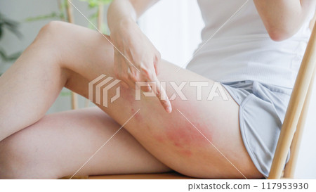 Woman scratching eczema on her thigh Woman scratching eczema on her thigh 117953930