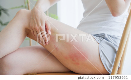 女人抓大腿濕疹 117953931