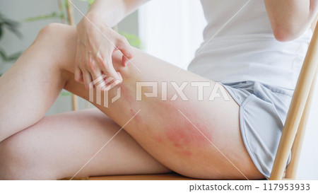 Woman scratching eczema on her thigh 117953933
