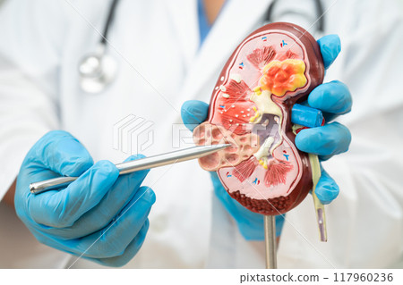 Kidney disease, Chronic kidney disease ckd, Doctor hold human model to treat and study in hospital. 117960236