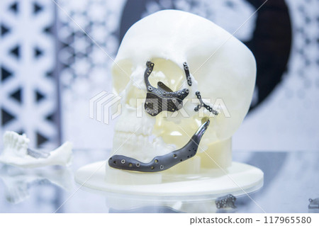Prototype of human skull from white plastic with titanium implants in form of plates and surgical templates printed on 3D printer. Biointegrated prosthesis. Medicine medical 117965580