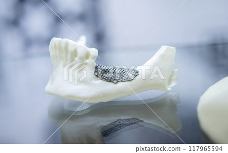 Prototype of lower human jaw with medical titanium implant from biocompatible titanium printed on 3D printer. Maxillo-facial prosthesis anatomical human bone from metal powder. Medicine medical 117965594