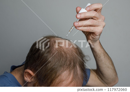 Mature man applying hair loss serum or minoxidil on bald scalp Mature man applying hair loss serum or minoxidil on bald scalp 117972060