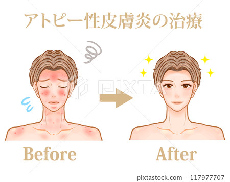 成年男性接受異位性皮膚炎治療前後的插圖素材 成年男性接受異位性皮膚炎治療前後的插圖素材 117977707