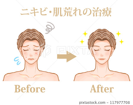 一名成年男子在美容皮膚科醫生處接受痤瘡治療前後的插圖材料 一名成年男子在美容皮膚科醫生處接受痤瘡治療前後的插圖材料 117977708