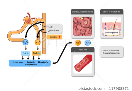 hypertonic, isotonic, and hypotonic dehydration, their causes, and the hormonal influence on water and salt loss. 2d graphic 117988871
