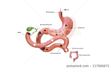 Digestive process after surgery: stomach, food pathway, duodenoileostomy, bile flow, alimentary limb, common channel, and ascending colon, 3d graphic 117988872