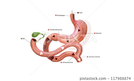 Digestive process after surgery: stomach, food pathway, duodenoileostomy, bile flow, alimentary limb, common channel, and ascending colon, 3d graphic Digestive process after surgery: stomach, food pathway, duodenoileostomy, bile flow, alimentary limb, common channel, and ascending colon, 3d graphic 117988874