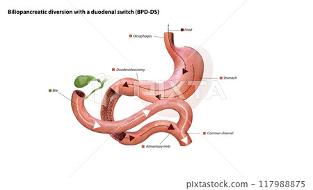Digestive process after surgery: stomach, food pathway, duodenoileostomy, bile flow, alimentary limb, common channel, and ascending colon, 3d graphic Digestive process after surgery: stomach, food pathway, duodenoileostomy, bile flow, alimentary limb, common channel, and ascending colon, 3d graphic 117988875