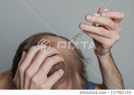 Hair loss person with serum peptide or minoxidil. Balding man head close-up.  117992150