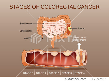 Stages of colorectal cancer Stages of colorectal cancer 117997416