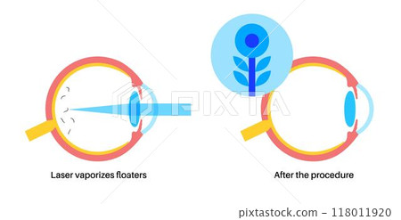 Vitreolysis laser treatment Vitreolysis laser treatment 118011920