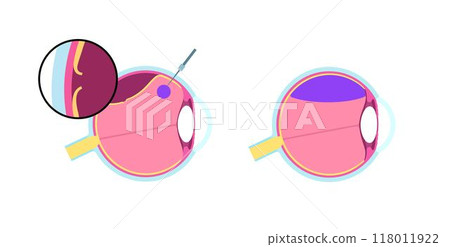 Pneumatic retinopexy poster 118011922