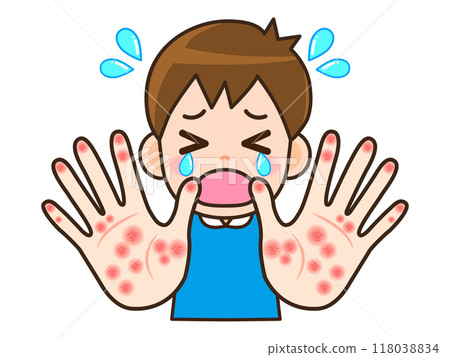 Illustration material of a man suffering from hand eczema and rough hands 118038834
