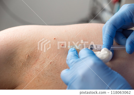 Surgeon gives injection of local anesthesia before laser removing of papillomas. 118063062