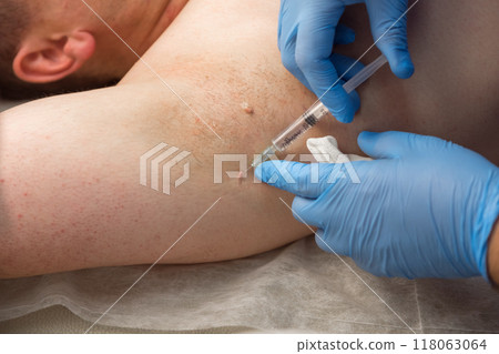 Surgeon gives injection of local anesthesia before laser removing of papillomas. 118063064