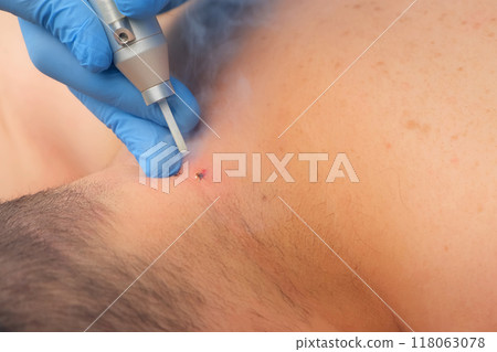 Surgeon removing moles using laser on man's neck, burning skin, closeup view. 118063078