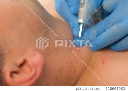 Surgeon removing moles using laser on man's neck, burning skin, closeup view. 118063083