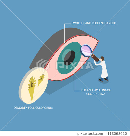 3D Isometric Flat Vector Illustration of Demodex Folliculorum, Demodicosis Affecting the Eyelid and Causing Red Eyes 118068610