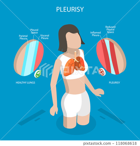 3D Isometric Flat Vector Illustration of Pleurisy Or Pleuritis Disease, Medical Overview of Lung Inflammation 3D Isometric Flat Vector Illustration of Pleurisy Or Pleuritis Disease, Medical Overview of Lung Inflammation 118068618